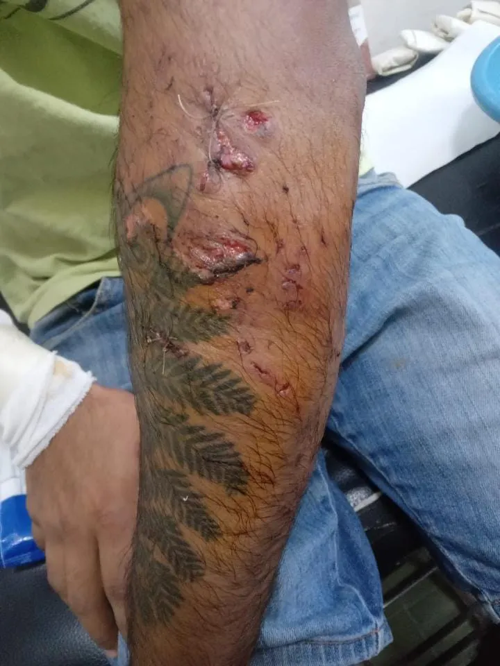 Así quedó el brazo del hombre